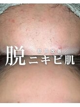 ソアスキン(SOAskin)&nbsp;ニキビケア 努力の結果