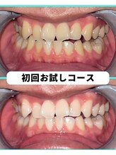 ホワイトニングビューティー 吉祥寺店/ホワイトニング　初来店