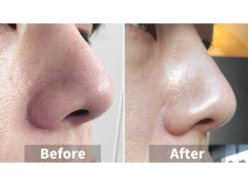 ラグラン銀座メディカルエステ 高輪ゲートウェイ店/最先端ハイドラフェイシャル♪