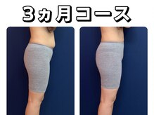 久留米スポーツ整骨院 整体院/エステ◆痩身インディバエステ