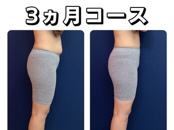 久留米スポーツ整骨院 整体院/エステ◆痩身インディバエステ