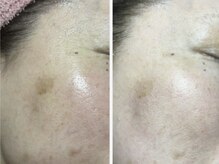 ドゥナ(DUNA)/7日間肌質改善