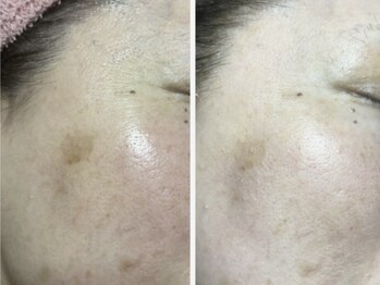 ドゥナ(DUNA)/7日間肌質改善