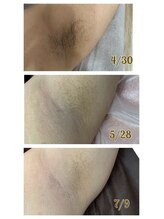 アンフルール(Une fleur)/ワキ脱毛で汗ムレ対策