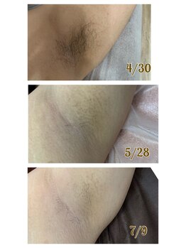 アンフルール(Une fleur)/ワキ脱毛で汗ムレ対策