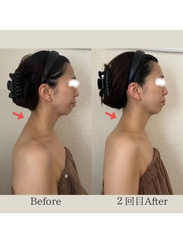 リーブル(LIBRE)/小顔コルギ 2回