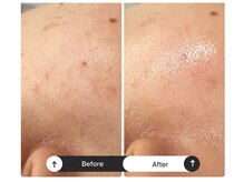 リジュ(Reje)/毛穴ケア