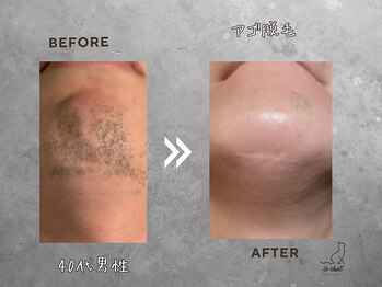 ル シャ/メンズ脱毛/毛穴洗浄/ヘッドスパ