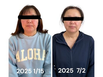 ブライトプラス(BRIGHT+)/毛穴洗浄+小顔ケア+小顔整体