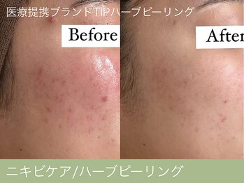 オーエン 小倉店(o-eN)/ニキビケア/ハーブピーリング