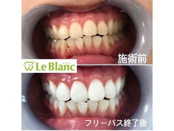 ルブラン 奈良店(Le Blanc)/白い歯！清潔感ありますね！