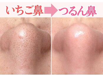 フェイシャルサロンFiore【フィオレ】の写真/頑固な黒ずみやいちご鼻、ニキビのお悩みの方へ。ブラシと吸引のダブル毛穴洗浄で、素肌を丁寧にケアします