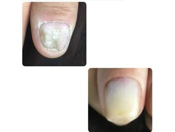 足爪の爪矯正 足爪のでこぼこ Pg ネイルクリニーク 福岡店 Nail Clinique のフォトギャラリー ホットペッパービューティー