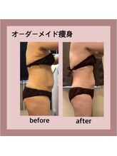 エステティック レイビス 秋田店(RAYVIS)/部分的に気になる部位にも◎