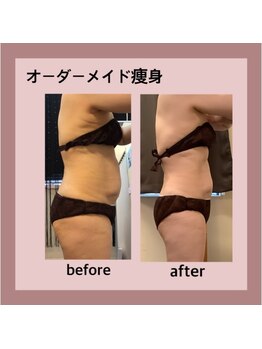 エステティック レイビス 秋田店(RAYVIS)/部分的に気になる部位にも◎