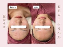 ルア(LuA.)/スピード改善！