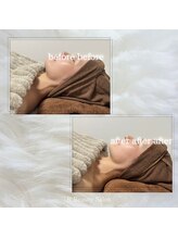 アールビューティーサロン(R Beauty Salon)/光フェイシャル/before after