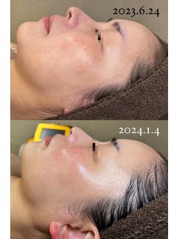 エクラ(ECLAT)/月に1度のACスペシャルケア