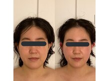 ハイコガオ 中崎町店(HIKOGAO)/小顔矯正60分