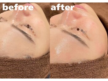 ホワイトラボ 堺東(White labo)/【20代女性 施術1回の効果】