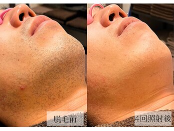 メンズアルファ/【髭】光脱毛before after 20代