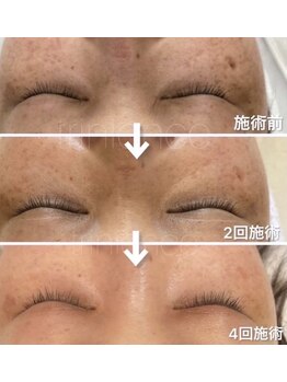 毛穴専科/シミケアでマイナス10歳肌