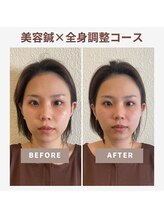 ベルソー鍼灸整体院(berceau鍼灸整体院)/【美容はり×根本改善】