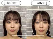 ビースタイル(B-style)/電気美容鍼ビフォーアフター