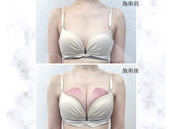 サロン アンネ(Anne)/本格エステ豊胸プログラム