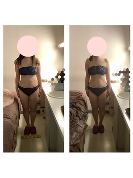 アクア エステティコ 亀有(ACQUA estetico)/脂肪燃焼　6回ビフォーアフター