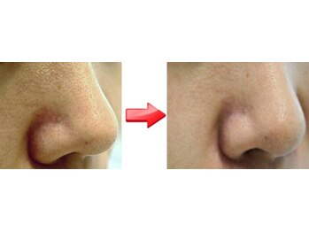 ラプレーヌ(La pleine)/お肌に優しいソフトピーリング