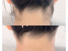 リリー(Lily)/【WAX脱毛】うなじ