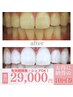 【★納得の価格と白さへ★10回コース】1来店2回（40分照射）黄ばみ積極撃退！