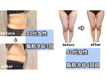 rvコーディネイトサロン(rv coordinate salon)/脂肪冷却の症例です(^^)/