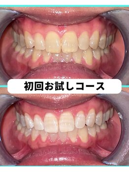 ホワイトニングビューティー 吉祥寺店/ホワイトニング 初来店