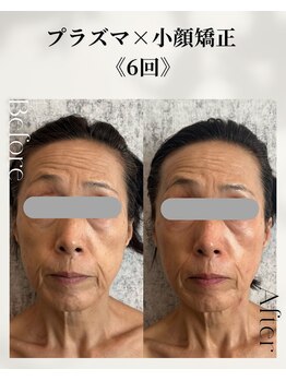 ネイルアンドアンチエイジングドゥシール(Docile)/60代女性｜たるみ・しわ改善