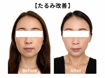 クローバー(clover)の写真/眠れるほど優しい小顔施術で、鏡を見るのが楽しみになるお顔へ◎東梅田に大人向けプライベートサロンOpen♪