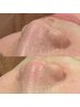 【土日祝も使用OK!】毛穴スッキリ洗浄ハイドロ(全顔/首)+美容液液導入