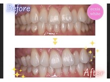 エクシアホワイトニング 可児店/ビフォーアフター