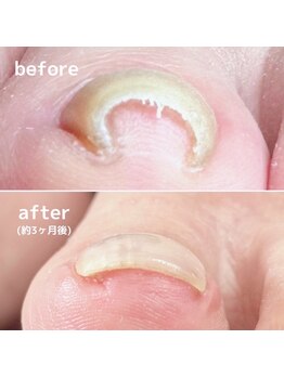 ビエル(BiEL)の写真/巻き爪や足の角質等のお悩みを解消！丁寧なカウンセリングで一人ひとりに最適なメニューを提案いたします♪