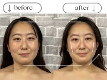 ビースタイル(B-style)/電気美容鍼ビフォーアフター