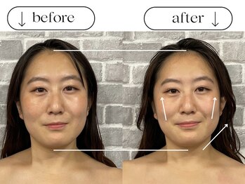 ビースタイル(B-style)/電気美容鍼ビフォーアフター