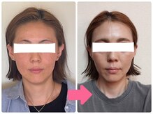 小顔矯正サロン ブルーム/お顔がキュッと引き締まり