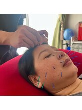 鍼灸マッサージ院 アカシア/性別年齢を問わない人気の美容鍼