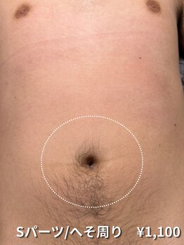 カナウ(KANAU)/【Sパーツ/脱毛】へそ周り