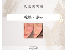スリースリー 恵比寿(THREE THREE)/乾燥・赤みケア 改善実績写真