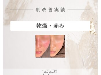 スリースリー 恵比寿(THREE THREE)/乾燥・赤みケア 改善実績写真