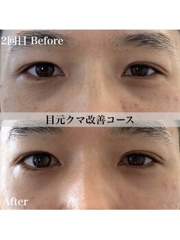 アール アンド ビューティーサロン(Ｒ＆ BeautySalon)/メンズ人気！クマ・眼精疲労ケア