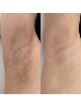 クク(ququ)/ローマピンク症例　脇