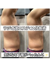 リエル(RIEL)/ラジオ波エステ